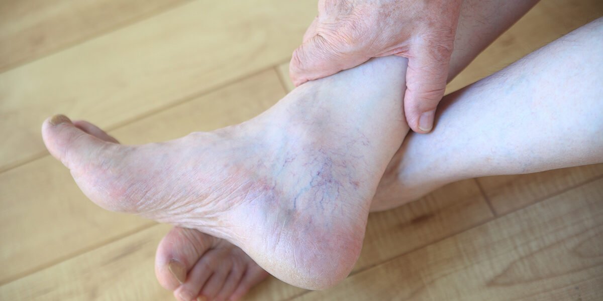 Are There Any Ways To Prevent And Remove Spider Veins?